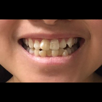 6 month braces 4 before